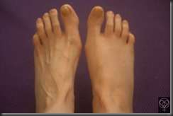 20130411_footswollen_0746_002